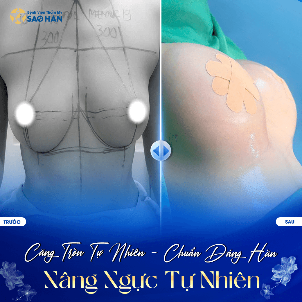 Trước và sau nâng ngực tại Sao Hàn