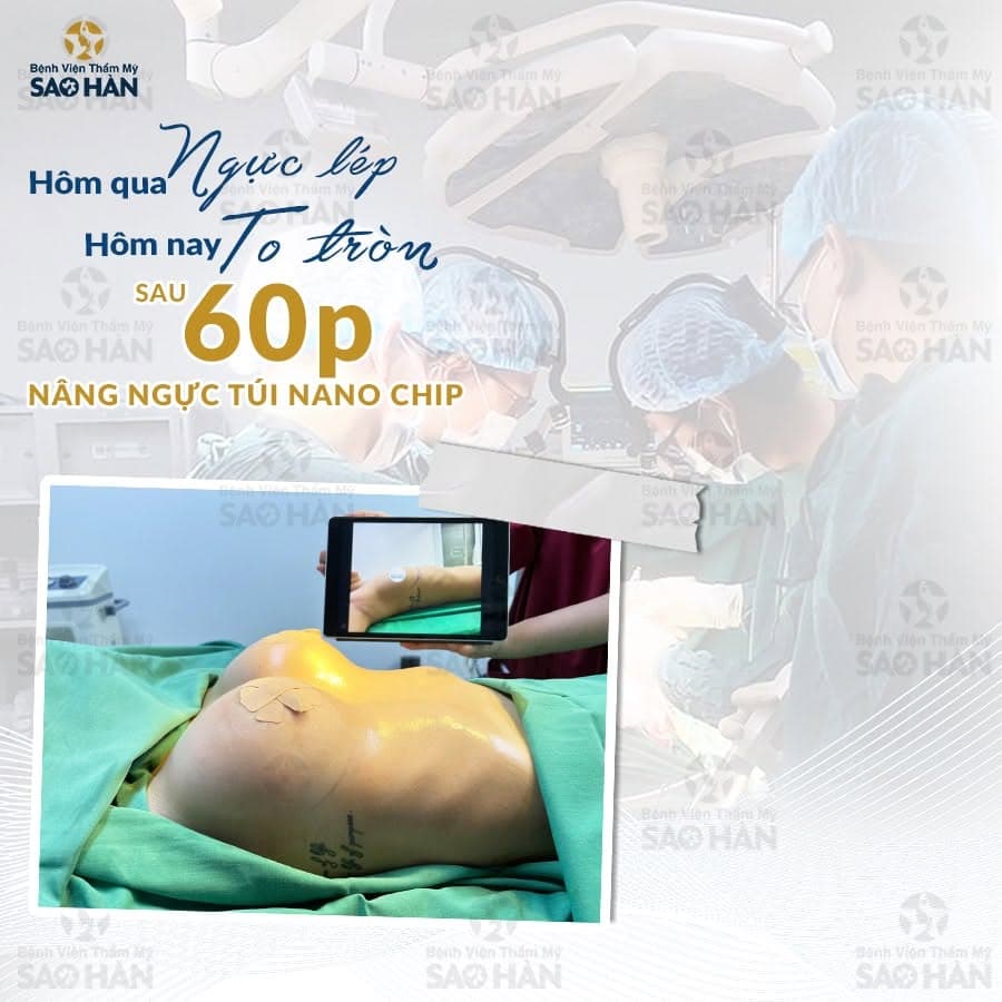 Nâng ngực túi Nano Chip là gì? Những điều cần biết trước khi thực hiện