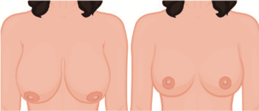 Đường rạch thu nhỏ ngực