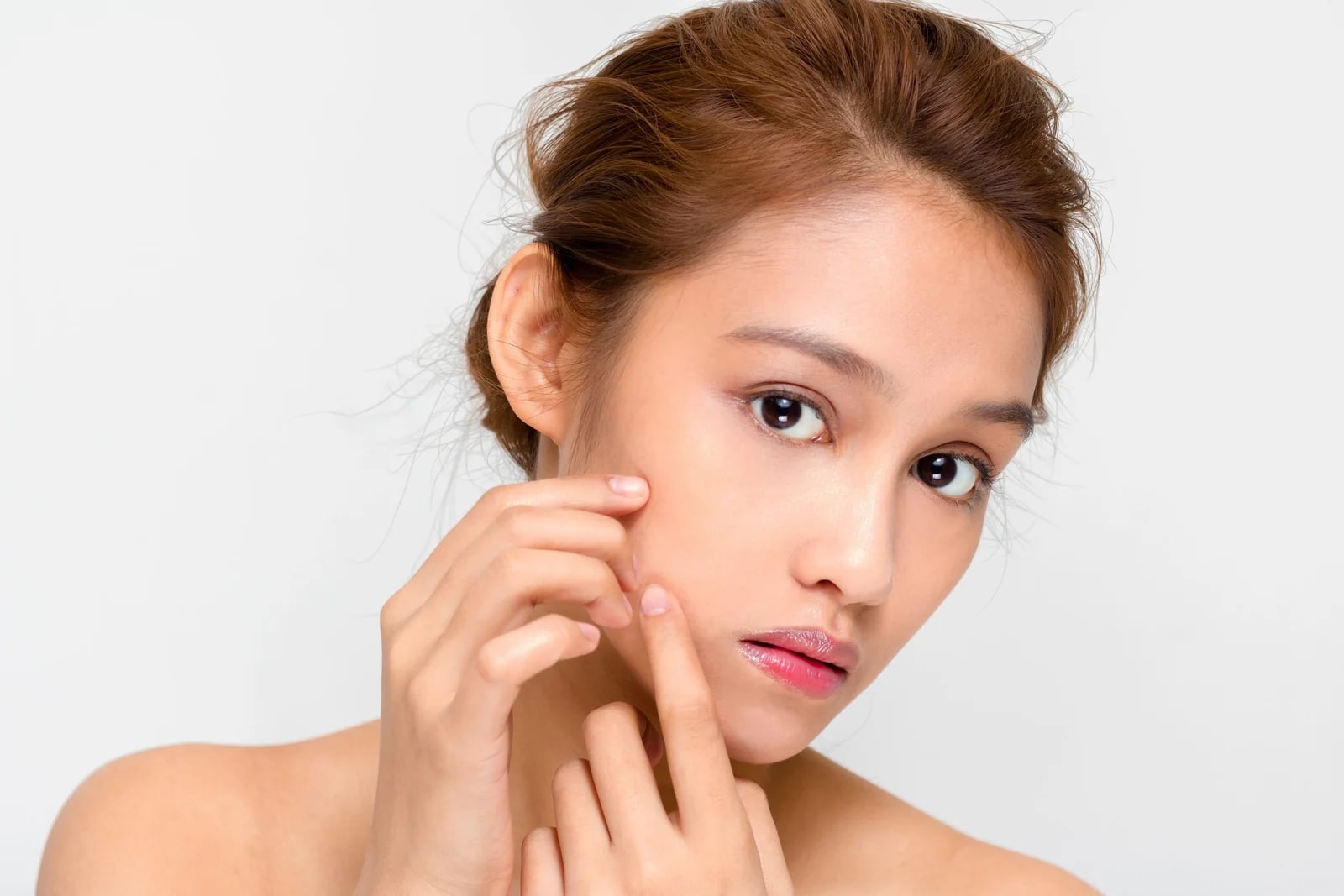 Điều trị mụn bằng IPL