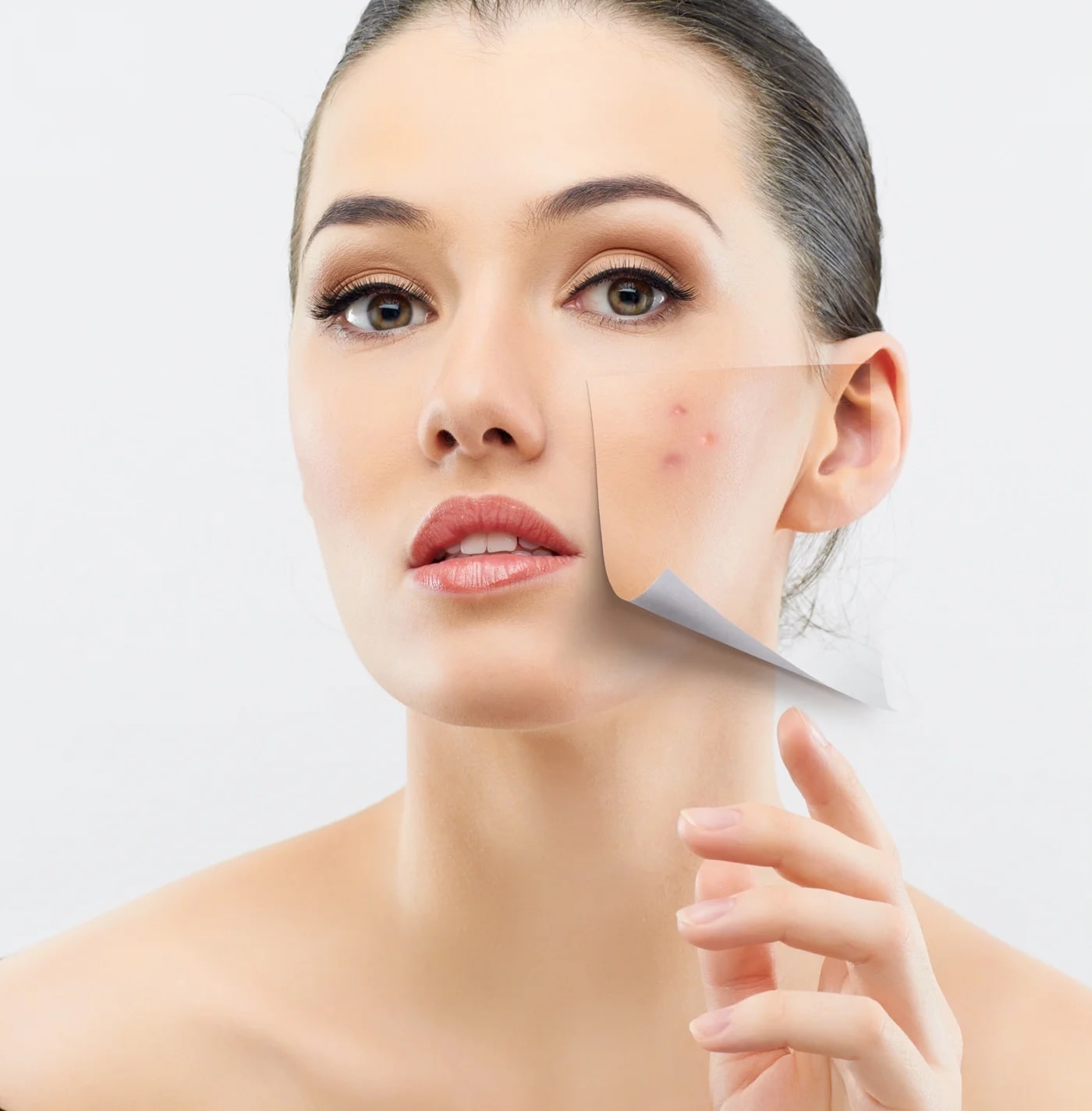 Điều trị mụn bằng IPL