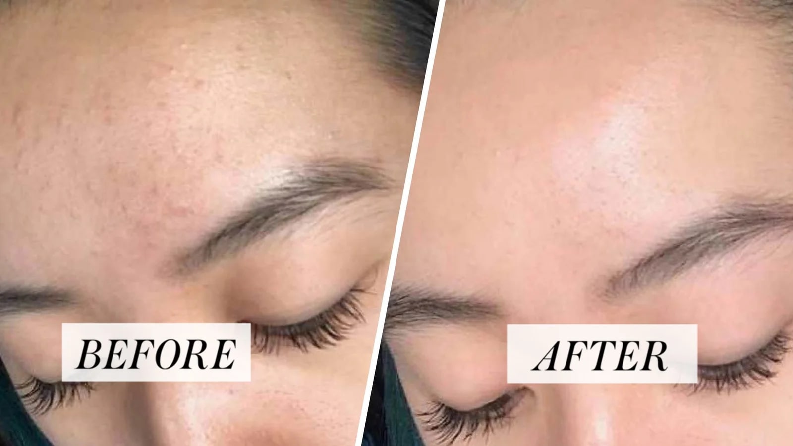 Kết quả điều trị mụn bằng IPL