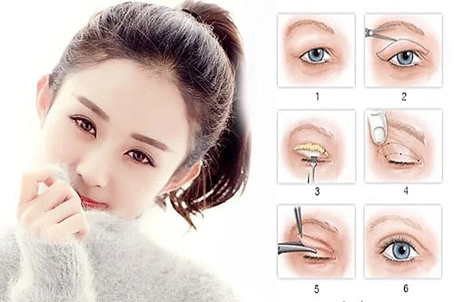 Chữa sụp mí mắt