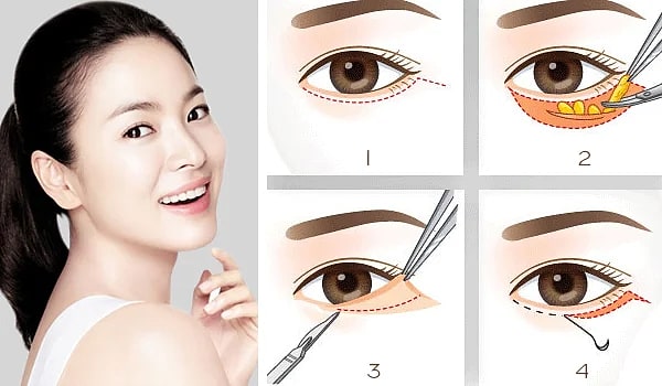 Lấy mỡ bọng mắt