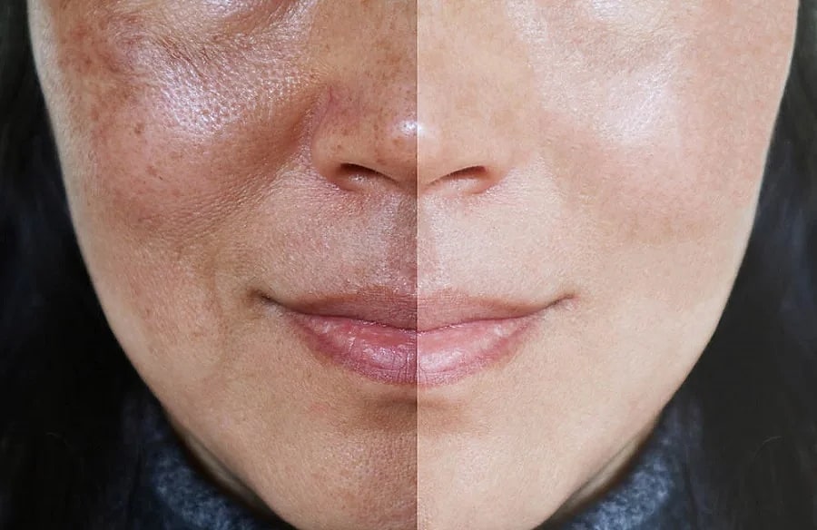 Điều trị nám tàn nhang
