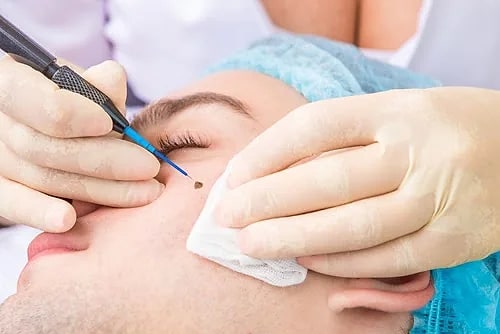 Xóa nốt ruồi
