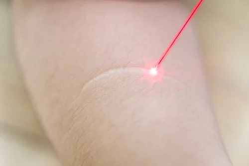 Điều trị sẹo lồi