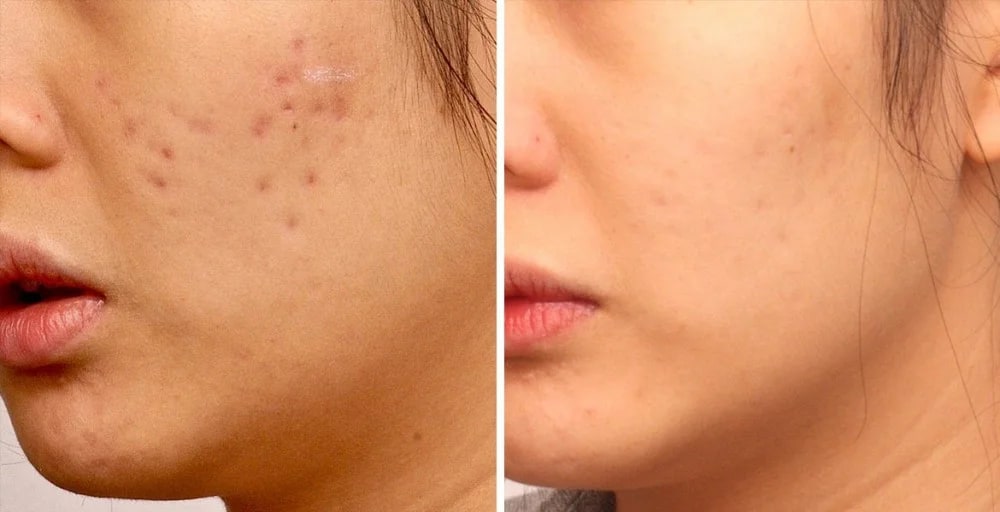 Điều trị sẹo lõm